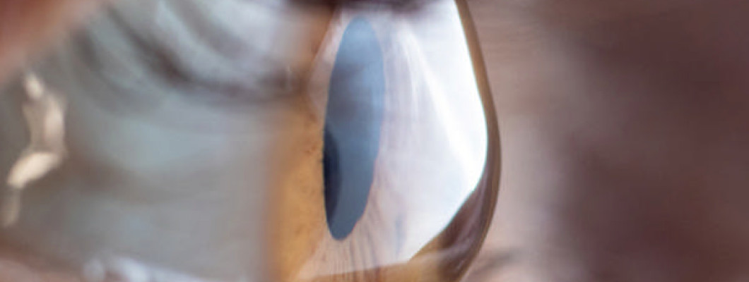 Cornea Transplant